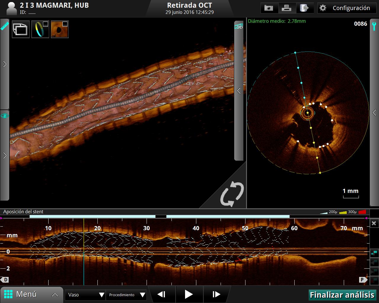 El nou stent des de tres angles.jpg